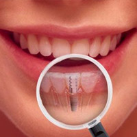 Impianti Dentali