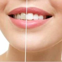 Sbiancamento dentale